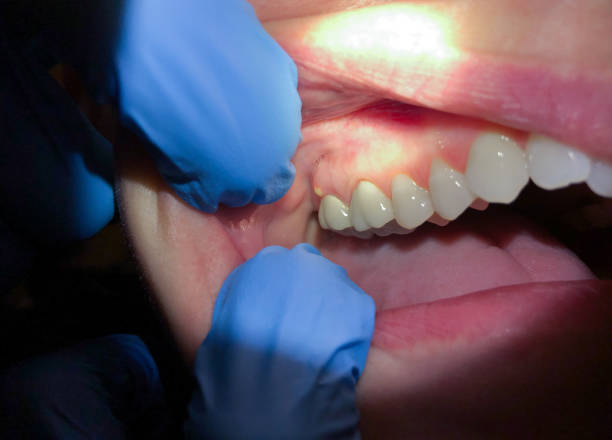 Best Lost Filling or Crown Replacement in Cibolo, TX