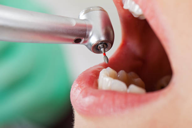 Best Emergency Root Canal Therapy in Cibolo, TX